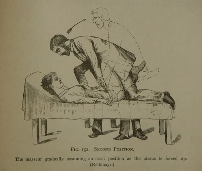 Ilustração médica antiga mostrando a técnica de 'massagem uterina' descrita em manuais do período